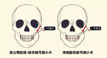 聯(lián)合麗格第 一醫(yī)院何照華院長：張力帶固定顴骨內(nèi)推與傳統(tǒng)顴骨手術(shù)有何區(qū)別？