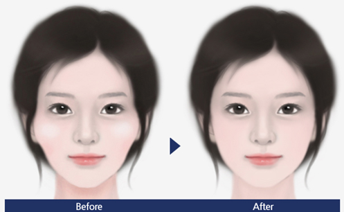 聯(lián)合麗格第一醫(yī)院何照華院長：顴骨內(nèi)推手術(shù)后，鈦釘用不用取出？