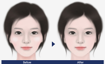 聯(lián)合麗格第 一醫(yī)院何照華院長：顴骨內推手術后，鈦釘用不用取出？